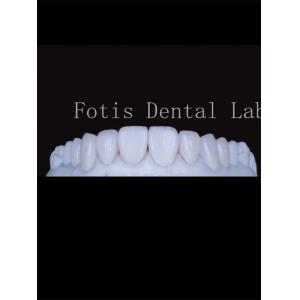 High Translucency Porcelain Tooth Veneers Enhance Your Smile Naturally