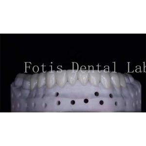 OEM ODM Stain Resistant Natural Looking Porcelain Veneers High Strength