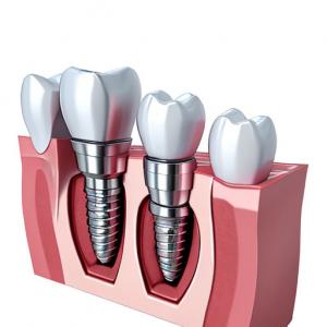 Embracing Technological Advancements The Future Of Dental Implant Crowns