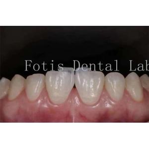 Polishing Synthetic Dental Laminate Veneers High Stain Resistance