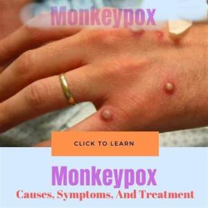 China CE Certified Monkeypox Rt-Pcr Assay Test Kit Monkeypox PCR Test Monkeypox Outbreak supplier