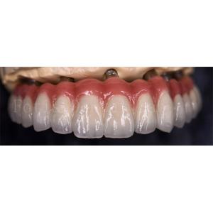 Staining Resistance  Dental Lab Crowns For Various Tooth Replacements