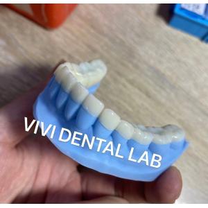 Designed Milled Dental Snap On Teeth For Increasing Vertical Bite