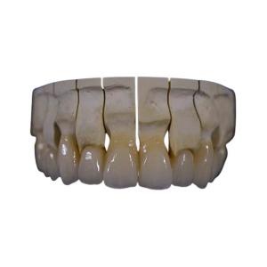 Full Mouth Zirconia Dental Crown Restoration Zirconia Fixed Bridge Chemical Resistance