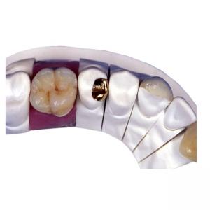 PFM Porcelain Dental Crown