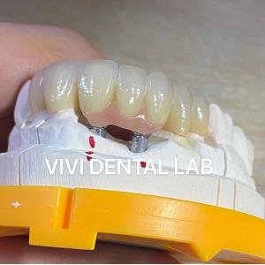 Porcelain Zirconia Dental Implant Bridge Professional High Esthetics
