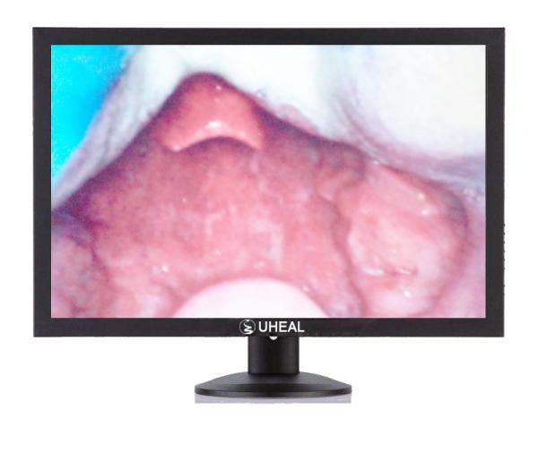 ICU Emergency Portable Video Laryngoscope with Big LCD Monitor 3 - 60mm