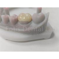 China OEM Dental Inlay And Onlay Ceramic Restoration And Tooth-Colored Filling on sale