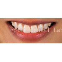 China High End Cosmetic Teeth Veneers For Perfect Smile Stain Resistance on sale