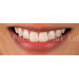 High End Cosmetic Teeth Veneers For Perfect Smile Stain Resistance