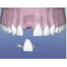 China Dentistry Implant of Maryland Dental Bridge With Natural Flexible Implant For Teeth Health wholesale