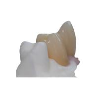 China Removable Pure Titanium Dental Implant Bar Custom Abutment on sale