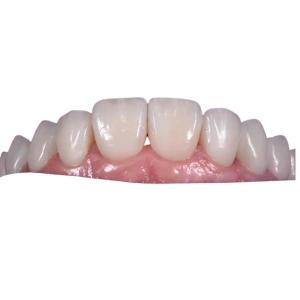 China 0.3MM Whitening Ceramic Dental Crown To Replace Unhealthy Teeth supplier