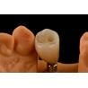 China Titanium Single Tooth Dental Implants Internal Hex Connection Type For Optimal Fit wholesale
