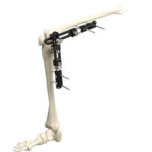 China Fixação externo externo ortopédica de alta qualidade Instrumen cirúrgico ortopédico de Fixator da articulação do joelho de instrumentos cirúrgicos supplier