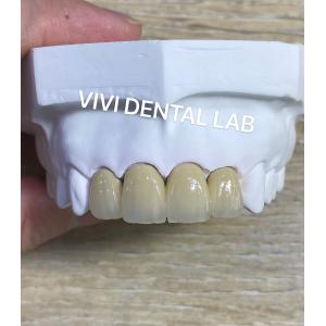 Dental Lab Metal Ceramic Crown PFM Crown High esthetics Perfect fit