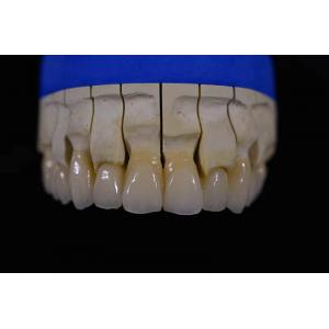 Denture Fabrication Lab Achieving Perfectly White Dentures with Zirconia Repair