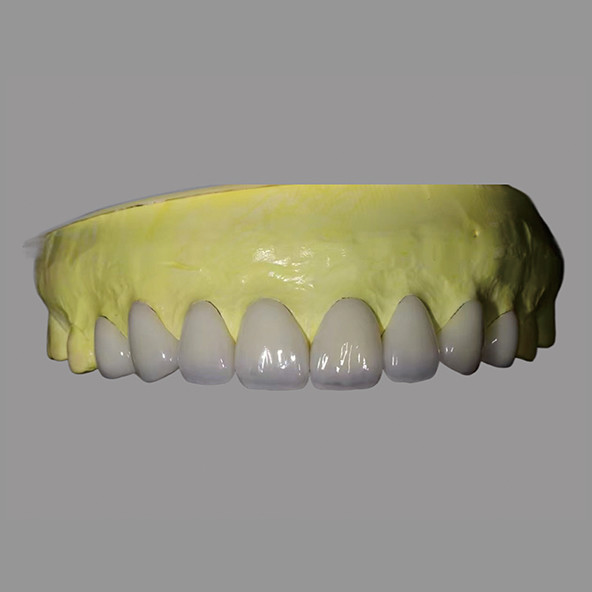 China High Translucency IPS E Max Veneers Stains Resistant Biocompatible wholesale