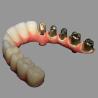 China Clase 2 Hybrid Malong Full Arch AOX Implant Bridge Barra de titanio con zirconio sólido completo wholesale