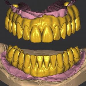 3 Shape Dental Crown Design / Exocad Implant Design ISO Approved