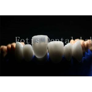 Long-Lasting and Durable Prosthetic Laminate Veneers with Porcelain Material
