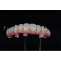 China Natural looking Full Chewing Ability Restoration with 4 Or 6 Implants on sale