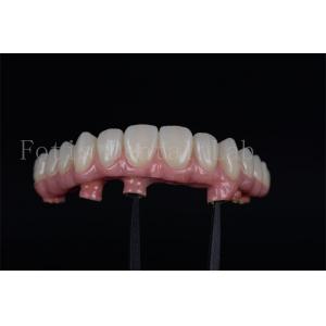 Natural looking Full Chewing Ability Restoration with 4 Or 6 Implants