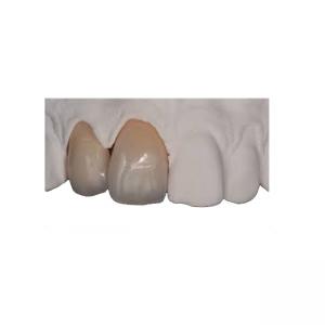 Body Strength Thin Zirconia Crown Durable Natural Realistic Restoration