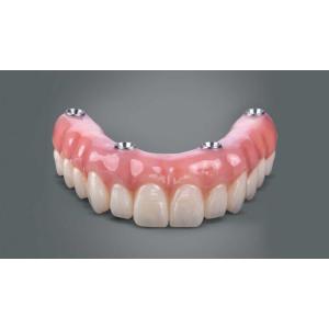 Dental All On 4 Implant Supported Dentures Professional Natural Looking