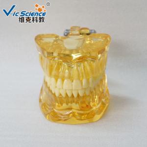 Full Mouth Teeth Pathology Model Teeth Models For Education With Half Implant