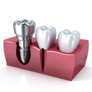 A Fusion Of Art And Science Our Dental Implant Crowns