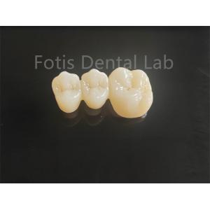 High Strength Porcelain Layered Zirconia For Long Lasting Dental Bridges