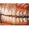 China Teeth Clenching Dental Night Guard Occlusal Plane Dentist Mouthguard Clear Hard Acrylic wholesale