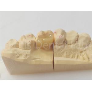 Precision Dental Inlay And Onlay For Accurate And Durable Restorations