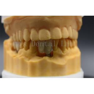 Custom Made Dental Implant Crown Precision Fit For Missing Teeth