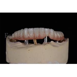 Affordable Natural Looking 4 Or 6 Implants Full Arch Success Rate Minimally Invasive Solution