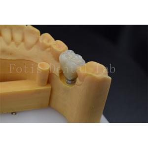 Easy To Place And Adjust Implant Retained Crown Polished Surface Treatment
