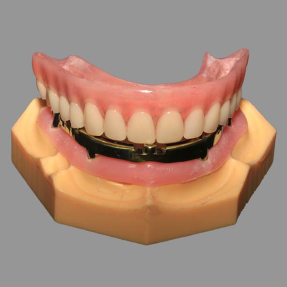 Full Acrylic Denture All On X Dental Implants AOX Class 4 With Locator Attachment