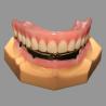 China Prótesis Acrílica Completa Sobre Implantes Dentales All On X AOX Clase 4 Con Anclaje Locator wholesale