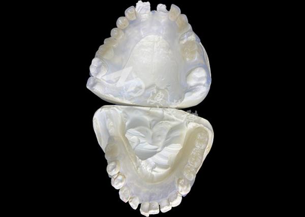 Prothèse amovible sur mesure pour améliorer la mastication et la parole
