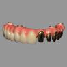China Clase 2 Hybrid Malong Full Arch AOX Implant Bridge Barra de titanio con zirconio sólido completo wholesale