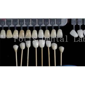 Customization Natural Dental Veneers Fake Teeth Overlays High Strength