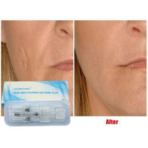 Hyaluronic Acid Injectable Filler 10ml For Lip Injection Cheeks Chin Augmentation