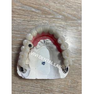 Cement Teeth Implant Dental Bridge PFM Screwed Metal Porcelain