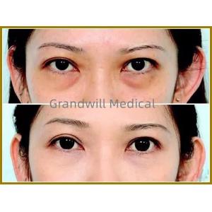 Hyaluronic Acid Facial Dermal Fillers For Filling Tear Trough Eye Circle