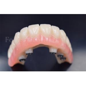 Customized Dental Implants Crowns Replacement Wear Resistance