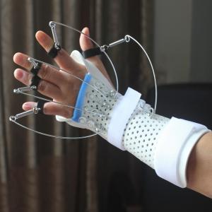 Thermoplastic Dynamic Extension Splint For Radial Nerve Palsy