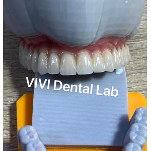 Translucency Digital Dental Crowns Teeth High Esthetics Customized