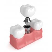 China True Dentures Implants Single All Ceramic Dentures Missing Teeth Fillings on sale