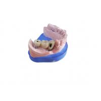 China CAD CAM Zirconia Dental Crown With Titanium Base Zirconia Abutment on sale